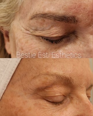 Smart Tox - Injectable tox is great for any area of the face whether you want a refreshing to your appearance or to obliterate wrinkles. It can work wonders. Smart Tox - Injectable tox is great for any area of the face whether you want a refreshing to your appearance or to obliterate wrinkles. It can work wonders.