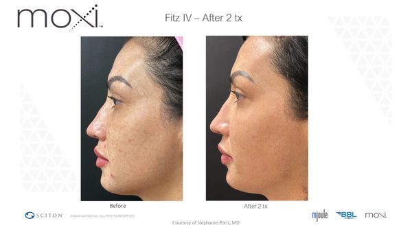 Moxi Laser Treatment - Our award winning Moxi laser treatment was designed for patients of color who want to reduce unwanted pigmentation like sun damage and Melasma.  Its safe and effective on ALL skin types.  Give us a call at 661-259-8100 for a free consultation to see if our Moxi laser treatment is right for you.