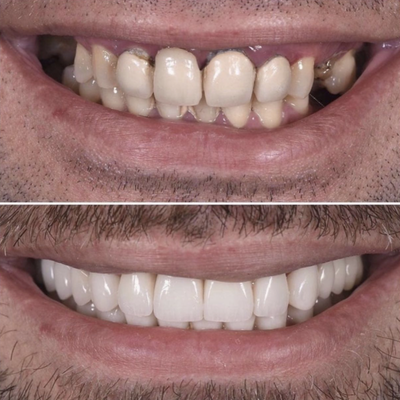 Crowns - Crown Cases Crowns - Crown Cases