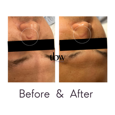 Scar Treatment - This gentleman came in to minimize the appearance of the scar on his nose. Before the treatment, the scar on the nose was prominent, marked by a noticeable depth and discoloration. After four microneedling sessions, the improvement is remarkable. The scar's appearance has significantly softened, with both texture and color blending more naturally into the surrounding skin. This non-invasive procedure, by stimulating collagen production, has effectively minimized the scar, enhancing the skin's overall appearance and texture. The after photo reveals a visibly smoother, more uniform complexion, showcasing the transformative power of microneedling in enhancing skin health and confidence.