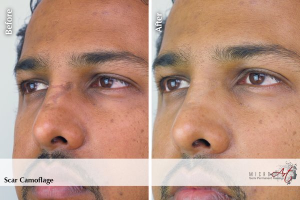 Scar Camouflage - MicroArt Semi-Permanent Makeup is a unique and revolutionary technology used to camouflage scars. It works by applying a mineral-based pigment into the scar to change its color so that it blends into the surrounding skin color to match and becomes unnoticeable. MicroArt Scar Camouflage treatment conceals scars on the face or body caused by accidents or surgeries.