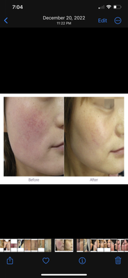 Pigmentation & Vascular Lesions Laser Treatments - Suffering from Rosacea or redness on your face?
Alma Harmony XL PRO may be the perfect solution for you! This device uses Intense Pulsed Light (IPL) to heat up and destroy the hemoglobin in the target tissue, which will reduce veins and redness. Not only does this device reduce redness and veins, but it also targets melanin which reduces pigment. This makes it an incredibly effective treatment for clearing the skin. So if you are looking to take care of your vascular lesions and redness, look no further than Namaste Day Spa and Organic Skin Shop.
https://namastespakelowna.com/pigmentation-vascular-lesions/ Pigmentation & Vascular Lesions Laser Treatments - Suffering from Rosacea or redness on your face?
Alma Harmony XL PRO may be the perfect solution for you! This device uses Intense Pulsed Light (IPL) to heat up and destroy the hemoglobin in the target tissue, which will reduce veins and redness. Not only does this device reduce redness and veins, but it also targets melanin which reduces pigment. This makes it an incredibly effective treatment for clearing the skin. So if you are looking to take care of your vascular lesions and redness, look no further than Namaste Day Spa and Organic Skin Shop.
https://namastespakelowna.com/pigmentation-vascular-lesions/