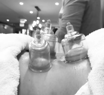 Cupping Therapy - Cupping therapy is good for individuals dealing with muscle, tendon, and myofascial tension. It works particularly well for a widespread region of tightness because we can treat a large area at one time. It is used for people dealing with muscle knots or trigger points, tendinitis, or bursitis. The cups come in many sizes to treat different regions of the body but our most common use in the clinic is for neck and back pain.
