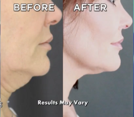 Scarlet SRF - Microneedling - Scarlet SRF combines two therapies: radiofrequency and micro-needling, and it is known as a non-surgical facelift. The two therapies effectively increase skin density to rejuvenate the skin, leading to decreased sagging and improved firmness. Scarlet SRF - Microneedling - Scarlet SRF combines two therapies: radiofrequency and micro-needling, and it is known as a non-surgical facelift. The two therapies effectively increase skin density to rejuvenate the skin, leading to decreased sagging and improved firmness.