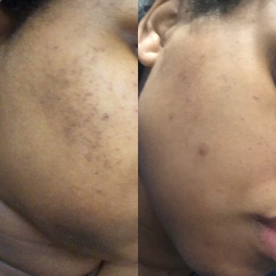 Gain healthy skin with a good acne treatment - Invest in yourself to get rid of acne and acne scars