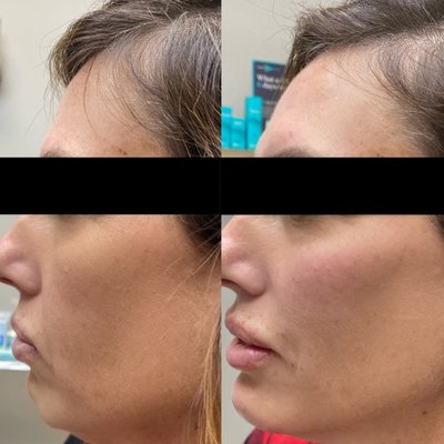 Anti-aging cheek lift - We customize each treatment to achieve optimal results. Skin Theory’s elite injectors have years of aesthetic training and anatomical knowledge for a one of a kind personalized treatment. Anti-aging cheek lift - We customize each treatment to achieve optimal results. Skin Theory’s elite injectors have years of aesthetic training and anatomical knowledge for a one of a kind personalized treatment.