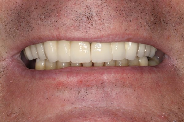 Gaps and Worn Teeth Fixed! - When Dr. Edwards' patient was concerned with how short his teeth were getting and the empty spaces between his teeth.  Using a combination of porcelain bridges and crowns, Dr. Edwards was able to correct the issues and make his patient very happy!