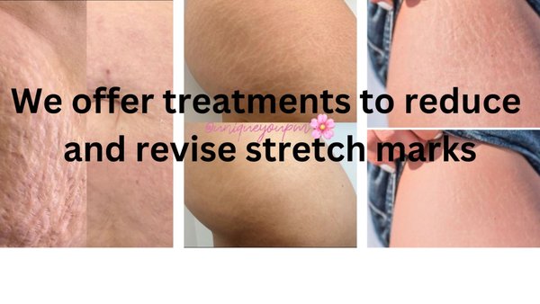 Reduce & Revise Stretch Marks - We offer treatments to reduce and revise stretch marks Reduce & Revise Stretch Marks - We offer treatments to reduce and revise stretch marks