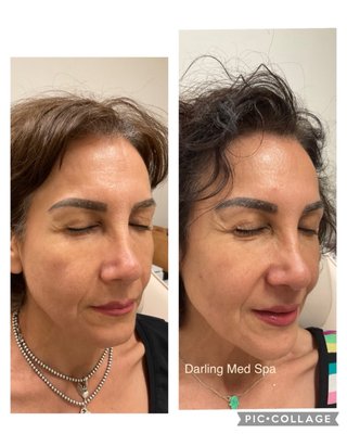 Sculptra Injections - Sculptra is a biostimulator that improves skin texture and restores loss of facial volume due to aging. Patients like it because Its longer lasting than hyaluronic acid filler and looks even more natural and gives the skin a youthful boost of collagen Sculptra Injections - Sculptra is a biostimulator that improves skin texture and restores loss of facial volume due to aging. Patients like it because Its longer lasting than hyaluronic acid filler and looks even more natural and gives the skin a youthful boost of collagen