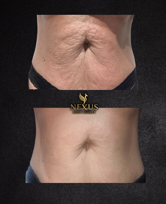 T-Shape 2  Skin Tightening - T-Shape 2 is the advanced, non-invasive solution that smooths, tones, and tightens your body. This powerful technology combines radiofrequency, laser, and vacuum therapy to actively reduce cellulite, enhance your physique, and improve muscle tone with visible results.