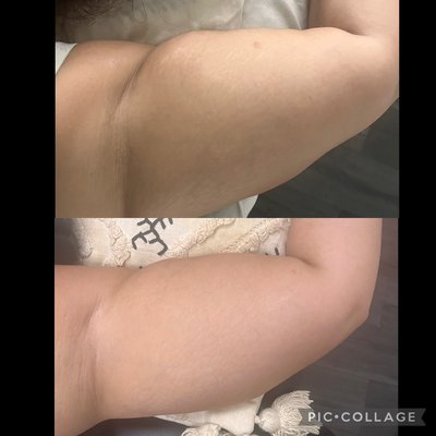 Body contouring - Body Contouring | Non-Invasive Body Sculpting at Elite Beauty Bar

Transform your confidence with our non-invasive body contouring treatments, designed to help sculpt, tone, and define your natural curves—without surgery, needles, or downtime. Whether you’re looking to target stubborn fat, tighten skin, improve the appearance of cellulite, or enhance your body’s natural shape, our customized body sculpting treatments are designed to support your body goals safely and effectively.

Our advanced body contouring services use professional technology to help reduce the appearance of stubborn fat pockets, stimulate collagen production, improve circulation, encourage lymphatic drainage, and tighten the skin for a smoother, firmer, more sculpted appearance. Every treatment is customized to your unique goals for optimal results.

Body contouring can help improve the appearance of:
✨ Abdomen & stomach
✨ Waist & love handles
✨ Arms
✨ Thighs
✨ Hips
✨ Buttocks
✨ Back fat
✨ Bra bulge
✨ Chin & jawline (if applicable)

Benefits of Body Contouring:
• Non-invasive body sculpting
• No surgery
• No needles
• No anesthesia
• No downtime
• Helps reduce the appearance of stubborn fat
• Improves body definition
• Supports skin tightening
• Helps improve the appearance of cellulite
• Encourages lymphatic drainage
• Stimulates circulation
• Promotes collagen and elastin production
• Helps smooth uneven skin texture
• Comfortable and relaxing treatments
• Customized treatment plans
• Safe for most body types

Our body contouring treatments are perfect for individuals who maintain a healthy lifestyle but struggle with stubborn areas that are resistant to diet and exercise. While body contouring is not a weight-loss treatment, it can help enhance your natural shape and improve overall body confidence when combined with healthy habits.

During your appointment, we’ll evaluate your concerns and create a personalized treatment plan to help you achieve your desired look. Multiple sessions are typically recommended for the best visible results, as improvements occur gradually over time.

Experience a relaxing, professional environment where your comfort and confidence are our priority. Let us help you feel your best with customized body sculpting treatments tailored just for you.

Book your Body Contouring consultation today and start your journey toward a smoother, firmer, more sculpted silhouette!

SEO Keywords: Body Contouring, Body Sculpting, Non-Invasive Body Contouring, Body Sculpting Near Me, Fat Reduction, Fat Cavitation, Radio Frequency Skin Tightening, Skin Tightening, Cellulite Reduction, Cellulite Treatment, Body Slimming, Waist Slimming, Tummy Contouring, Abdomen Contouring, Stomach Fat Reduction, Love Handle Reduction, Arm Contouring, Thigh Slimming, Butt Lift, Lymphatic Drainage, Collagen Stimulation, Elastin Production, Body Firming, Body Toning, Inch Loss, Non-Surgical Body Contouring, Body Shaping, Contoured Body, Beauty Spa, Wellness, Aesthetic Treatments, Elite Beauty Bar.

Results vary from person to person. Body contouring is intended for body shaping and contour enhancement and is not a substitute for weight-loss treatments or medical care.