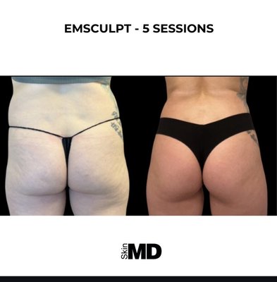 Emsculpt - EMSCULPT® is an entirely non-invasive procedure that utilizes HIFEM, High-Intensity Focused Electromagnetic technology, causing specific muscle reactions, called supramaximal contractions. The muscles respond with a profound remodeling of their inner structure, i.e., the growth of myofibrils (muscle hypertrophy) and the creation of new protein strands and muscle fibers (muscle hyperplasia).
The process results in a concurrent increase in both muscle density and volume. EMSCULPT® simultaneously builds muscle and burns fat. Emsculpt - EMSCULPT® is an entirely non-invasive procedure that utilizes HIFEM, High-Intensity Focused Electromagnetic technology, causing specific muscle reactions, called supramaximal contractions. The muscles respond with a profound remodeling of their inner structure, i.e., the growth of myofibrils (muscle hypertrophy) and the creation of new protein strands and muscle fibers (muscle hyperplasia).
The process results in a concurrent increase in both muscle density and volume. EMSCULPT® simultaneously builds muscle and burns fat.