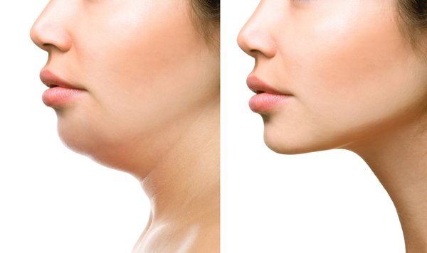 Fat Dissolving Double Chin Injection. - Diminish the double chin with a treatment tailored for you. The double chin injection is a fat dissolving injection that is administered as a series of injections to the treatment area under the chin, destroying fat cells and generating results. Every host's facial profile is different, so the treatment will be tailored to suitable candidates. The use of double chin injection is widely known to improve the appearance and profile of moderate to severe fat below the chin (Submental Fat), also called "Double Chin". Fat Dissolving Double Chin Injection. - Diminish the double chin with a treatment tailored for you. The double chin injection is a fat dissolving injection that is administered as a series of injections to the treatment area under the chin, destroying fat cells and generating results. Every host's facial profile is different, so the treatment will be tailored to suitable candidates. The use of double chin injection is widely known to improve the appearance and profile of moderate to severe fat below the chin (Submental Fat), also called "Double Chin".