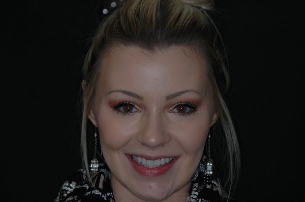 Smile Makeover - Veneers - This patient had always wanted whiter, straighter teeth. She finally decided that she was going to make the investment in her smile and with eight veneers she was able to get the smile she had always dreamed of. Smile Makeover - Veneers - This patient had always wanted whiter, straighter teeth. She finally decided that she was going to make the investment in her smile and with eight veneers she was able to get the smile she had always dreamed of.