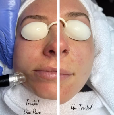 HydroFacial - We use water-based solutions, so individuals of all skin types can benefit from this treatment!
Dead skin cells are gently removed, leaving behind a fresh skin layer. Strong suction, exfoliating, and massaging increase blood flow and collagen production. No pain, no discomfort! The micro-current and LED light are extremely beneficial for decreasing puffiness and lifting muscles to tone the face. LED therapy has a range of therapeutic benefits.
RF Therapy helps to eliminate wrinkles and fine lines. You'll also notice a tighter skin tone! To top off this luxurious treatment, we also use Environ Skin products to cleanse the skin. HydroFacial - We use water-based solutions, so individuals of all skin types can benefit from this treatment!
Dead skin cells are gently removed, leaving behind a fresh skin layer. Strong suction, exfoliating, and massaging increase blood flow and collagen production. No pain, no discomfort! The micro-current and LED light are extremely beneficial for decreasing puffiness and lifting muscles to tone the face. LED therapy has a range of therapeutic benefits.
RF Therapy helps to eliminate wrinkles and fine lines. You'll also notice a tighter skin tone! To top off this luxurious treatment, we also use Environ Skin products to cleanse the skin.