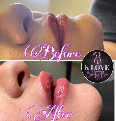 Hyaluron Lip pen Non invasive Lip filler - The Hyaluron Pen is an amazing treatment that deposits hyaluronic acid into the epidermal and upper layers of the skin, without the need of needles. This technology uses high pressure which causes the hyaluronic acid to turn into Nano Scale molecules that allow them to enter through the skin, without needles. The Hyaluron Pen can be used to improve the lips shape, lift and volume and can treat lips, nasolabial lines, marionette lines, 11 lines and forehead wrinkles.