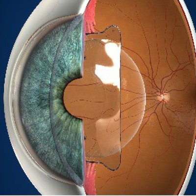 EVO ICL - EVO ICL, also called an Implantable Collamer Lens, is a refractive implant to correct common vision issues like myopia (nearsightedness) with or without astigmatism. Unlike some other vision correction options, the EVO ICL is an additive technology that corrects vision without the removal of any corneal tissue. Dr. Rivers performed this surgery in the US Military and now offers it to his patients at the National Harbor. EVO ICL - EVO ICL, also called an Implantable Collamer Lens, is a refractive implant to correct common vision issues like myopia (nearsightedness) with or without astigmatism. Unlike some other vision correction options, the EVO ICL is an additive technology that corrects vision without the removal of any corneal tissue. Dr. Rivers performed this surgery in the US Military and now offers it to his patients at the National Harbor.