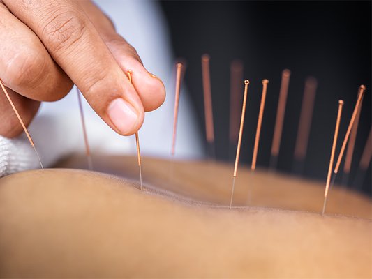 Offering at home cupping and dry needling - Contact today for at home services including cupping and dry needling! Offering at home cupping and dry needling - Contact today for at home services including cupping and dry needling!
