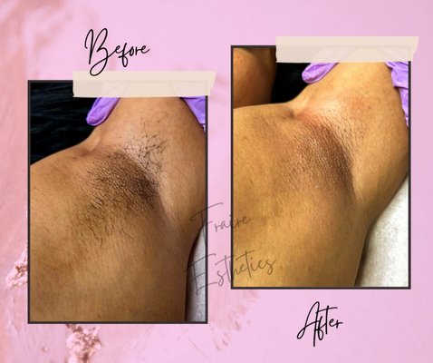 Underarm waxing - This was my clients first wax ever! She was very pleased with her results that she rebooked 💕 Underarm waxing - This was my clients first wax ever! She was very pleased with her results that she rebooked 💕