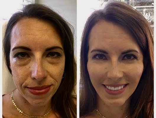 Facial Treatments Before & After - Here is an examples of many transformations that can happen with combination of facial treatments done at Satin Med Spa.. where Medical Aesthetics meets Natural Beauty Facial Treatments Before & After - Here is an examples of many transformations that can happen with combination of facial treatments done at Satin Med Spa.. where Medical Aesthetics meets Natural Beauty