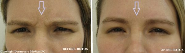 Botox treatment of facial wrinkles - Botox treatment of wrinkles between eyebrows and around eyes usually takes 10 minutes.