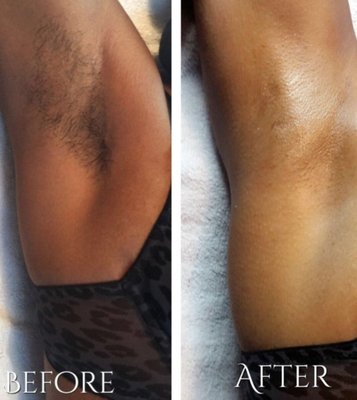 Underarm wax - Underarm wax, using hard wax for sensitive skin Underarm wax - Underarm wax, using hard wax for sensitive skin