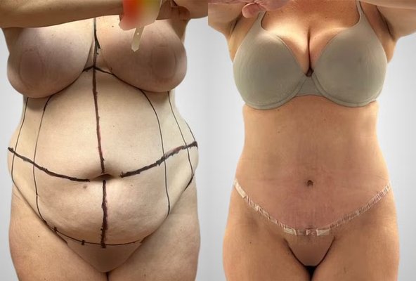 Tummy Tuck & Liposuction - Liposuction and extended tummy tuck by Dr. Walt Sweeney. Post-op photos were captured at 6 weeks. This gives an idea of how significant the change can be. Tummy Tuck & Liposuction - Liposuction and extended tummy tuck by Dr. Walt Sweeney. Post-op photos were captured at 6 weeks. This gives an idea of how significant the change can be.