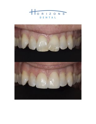 Smile makeover - Dr. Leyder began his career with eight years of experience in public health dentistry, where he treated dental trauma cases on a daily basis and developed a strong foundation in restorative care. After returning to private practice, he refined his skills and now proudly offers high-quality, same-day restorations that are both durable and aesthetically pleasing. Smile makeover - Dr. Leyder began his career with eight years of experience in public health dentistry, where he treated dental trauma cases on a daily basis and developed a strong foundation in restorative care. After returning to private practice, he refined his skills and now proudly offers high-quality, same-day restorations that are both durable and aesthetically pleasing.