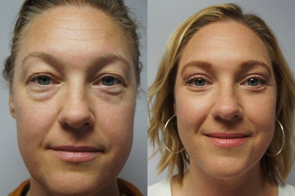 Blepharoplasty - Eyelid surgery is popular with men and women. Results of the surgery are helpful in presenting an energetic, attentive appearance in work and social situations.