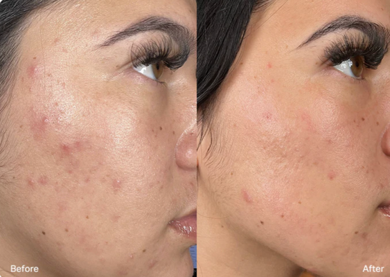Clear up your complexion - Get Clearer, More Even-Toned Skin

Shown to help reduce the appearance of acne breakouts, excess oil, and redness.

100% had clearer skin

95% reported less oil and congestion
