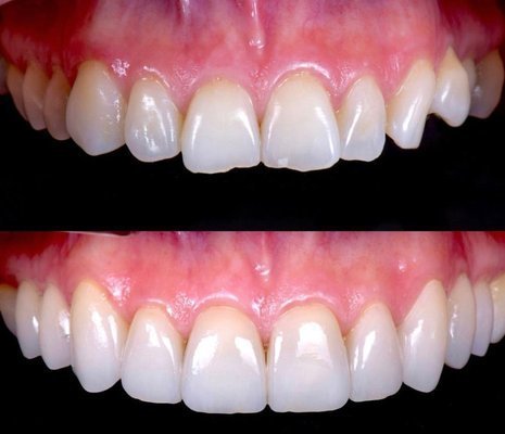 Composite Bondings - Composite Bonding cases