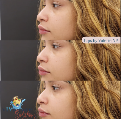 Dermal Filler - Dermal Filler in Philadelphia, PA, is ideal for individuals looking to reduce signs of aging or enhance their facial features without surgery. Most patients see immediate results, with optimal outcomes visible within a few days as swelling subsides. The effects of dermal fillers may last from six months to two years, depending on the filler used and the treatment area. For those interested in achieving a refreshed and youthful appearance, booking a Dermal Filler appointment at Viva Care Solutions in Philadelphia, PA, can be a convenient and effective option. Dermal Filler - Dermal Filler in Philadelphia, PA, is ideal for individuals looking to reduce signs of aging or enhance their facial features without surgery. Most patients see immediate results, with optimal outcomes visible within a few days as swelling subsides. The effects of dermal fillers may last from six months to two years, depending on the filler used and the treatment area. For those interested in achieving a refreshed and youthful appearance, booking a Dermal Filler appointment at Viva Care Solutions in Philadelphia, PA, can be a convenient and effective option.