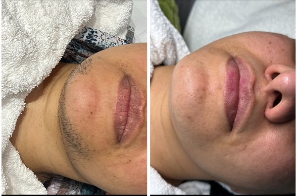 Laser Hair Removal - We offer Laser hair removal that is safe for all skin tones Laser Hair Removal - We offer Laser hair removal that is safe for all skin tones
