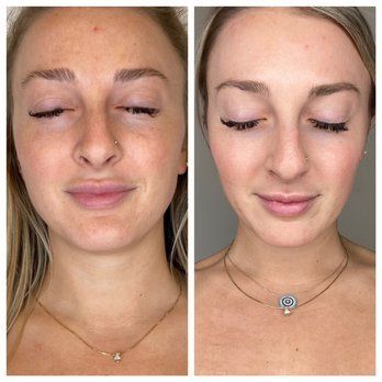 Restoration and Rejuvenation - Neurotoxin injections such as Botox, Dysport, or Xeomin help to relax muscles to reduce fine lines and wrinkles. Effect typically lasts about 3 months.
Fillers and biostimulants help to restore volume in areas that have "deflated" over time. Our skin's collagen content naturally declines over time. Fillers help to restore this more youthful appearance.
IPL and laser surfaces help resolve sun damage, improve fine lines and wrinkles, and promote skin tightening.
Microneedling and RF Microneedling increase collagen and elastin production, improve complexion, reduce acne scarring. These procedures are relatively painless, involve minimal downtime, and are safe for all skin types.
These services, in combination with medical grade skin care and sunscreen, facials, chemical peels, and LED therapy all help to maintain the glow of happy, healthy skin.
Our Medical Director, Andrew Donohoe, is board certified in Internal Medicine and brings this expertise to a comprehensive and thorough approach to aesthetics and wellness. Our medical wellness programs include weight loss, hormone balancing, and injection (IM) vitamins and supplements. Restoration and Rejuvenation - Neurotoxin injections such as Botox, Dysport, or Xeomin help to relax muscles to reduce fine lines and wrinkles. Effect typically lasts about 3 months.
Fillers and biostimulants help to restore volume in areas that have "deflated" over time. Our skin's collagen content naturally declines over time. Fillers help to restore this more youthful appearance.
IPL and laser surfaces help resolve sun damage, improve fine lines and wrinkles, and promote skin tightening.
Microneedling and RF Microneedling increase collagen and elastin production, improve complexion, reduce acne scarring. These procedures are relatively painless, involve minimal downtime, and are safe for all skin types.
These services, in combination with medical grade skin care and sunscreen, facials, chemical peels, and LED therapy all help to maintain the glow of happy, healthy skin.
Our Medical Director, Andrew Donohoe, is board certified in Internal Medicine and brings this expertise to a comprehensive and thorough approach to aesthetics and wellness. Our medical wellness programs include weight loss, hormone balancing, and injection (IM) vitamins and supplements.