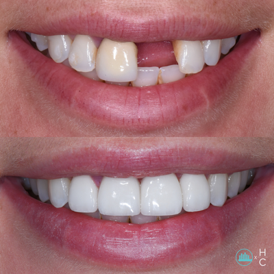 Dental Implants - Today, dental implants are the standard of care to replace missing teeth. Whether you are in need of multiple teeth replacements or just one, dental implants are the way to bring your smile back in the most aesthetically pleasing, least invasive way. By focusing on only the missing tooth, dental implants allow you to replace missing teeth without having to touch any adjacent teeth. The results are long lasting and beautiful. Dental Implants - Today, dental implants are the standard of care to replace missing teeth. Whether you are in need of multiple teeth replacements or just one, dental implants are the way to bring your smile back in the most aesthetically pleasing, least invasive way. By focusing on only the missing tooth, dental implants allow you to replace missing teeth without having to touch any adjacent teeth. The results are long lasting and beautiful.