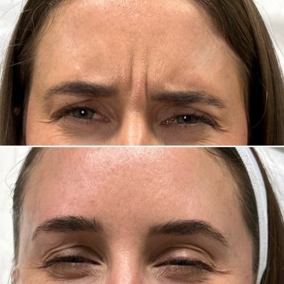 Neurotoxin (Botox, Dysport, Jeuveau) - Botox (neuromodulator) works by temporarily paralyzing specific muscles, smoothing out existing wrinkles and preventing new ones from forming. Neurotoxin (Botox, Dysport, Jeuveau) - Botox (neuromodulator) works by temporarily paralyzing specific muscles, smoothing out existing wrinkles and preventing new ones from forming.