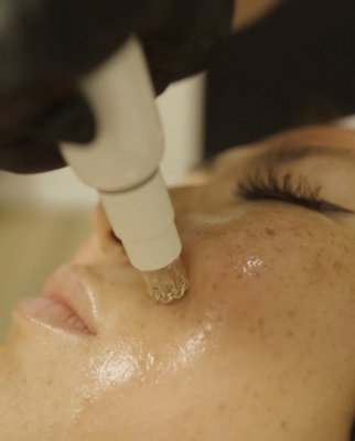 Microneedling + PRF - Microneedling + PRF
