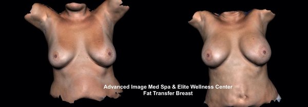 Fat Transfer Breast Augmentation - Fat transfer Breast Augmentation uses fat from your own body to enhance the size and improve the shape of your breasts. Because the “filler” is your body's own fat, results from a Fat Transfer Breast Augmentation can last for years. There is no general anesthesia used for this procedure making it very safe and effective.