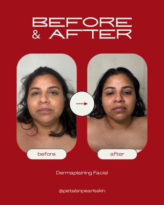 Facial Treatments - Some of my beautiful clients and their before and afters! A facial is such a necessity!