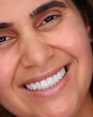Smile Makeover 10 Teeth | Translucent Porcelain Veneers - 10 Teeth Smile Design | Porcelain Smile Design Veneers: Finance Available with No interest up to 24mo. Get your Hollywood Smile NOW and pay letter. 20 years of experience. Affordable Dental Care. Finance Available. Enjoy this $129/Month special (50% Off Yelp Customers Deal) limited time. Boost your self-confidence with a new beautiful computerized perfect smile. Unbeatable Broward, Miami & Palm Beach Deal. Smile Makeover 10 Teeth | Translucent Porcelain Veneers - 10 Teeth Smile Design | Porcelain Smile Design Veneers: Finance Available with No interest up to 24mo. Get your Hollywood Smile NOW and pay letter. 20 years of experience. Affordable Dental Care. Finance Available. Enjoy this $129/Month special (50% Off Yelp Customers Deal) limited time. Boost your self-confidence with a new beautiful computerized perfect smile. Unbeatable Broward, Miami & Palm Beach Deal.