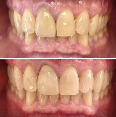 Invisalign - Invisalign Cases