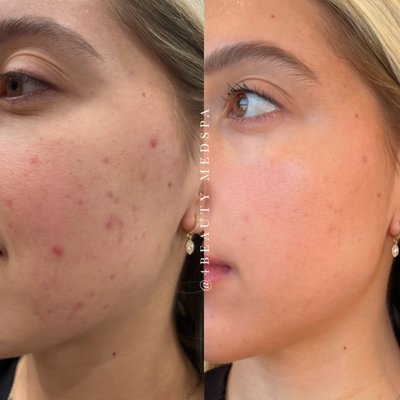 Skin Transformations - At 4Beauty Medspa, we understand that each skin is unique and requires personalized care. Our expert team is dedicated to addressing a variety of skin concerns with tailored solutions that promote optimal health and aesthetics. Whether you're dealing with premature aging, acne, hyperpigmentation, dryness, or sensitivity, we offer an extensive array of treatments designed to enhance and rejuvenate your skin.

Our services include advanced facials, chemical peels, laser therapy, microneedling, and more, each performed using the latest technology and highest quality products. We also specialize in preventive skincare, helping you maintain youthful, glowing skin. Let us help you find the perfect treatment plan to ensure your skin not only looks but truly feels its best.
