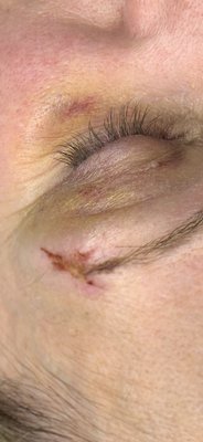 Scar treatment after injury. - This model needed 10 stitches after she got injured. Immediately we’ve started LED to prevent a scar on her beautiful face and followed the standard scar protocol. After the 7th session (2 weeks period) we were happy to see, how beautifully she is healing. Scar treatment after injury. - This model needed 10 stitches after she got injured. Immediately we’ve started LED to prevent a scar on her beautiful face and followed the standard scar protocol. After the 7th session (2 weeks period) we were happy to see, how beautifully she is healing.