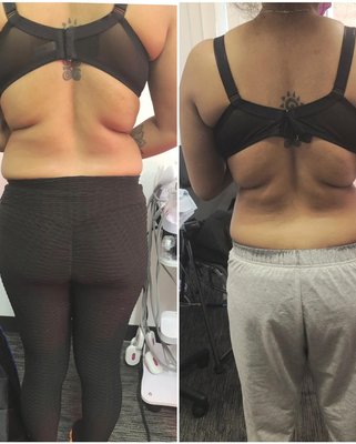 Before picture of Back and After picture of Back - Before and After services for stubborn Back fat, Cavitation on Abdominal followed by suctioning, and Emsculpt on Buttocks to build Muscle Mass. Before picture of Back and After picture of Back - Before and After services for stubborn Back fat, Cavitation on Abdominal followed by suctioning, and Emsculpt on Buttocks to build Muscle Mass.