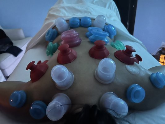 Cupping therapy at its finest! - You’d be surprised the amount of issues cupping, heat, and IASTM therapy can treat. 70-100% pain reduction and range of motion improvement within 2-4 treatments. Cupping therapy at its finest! - You’d be surprised the amount of issues cupping, heat, and IASTM therapy can treat. 70-100% pain reduction and range of motion improvement within 2-4 treatments.
