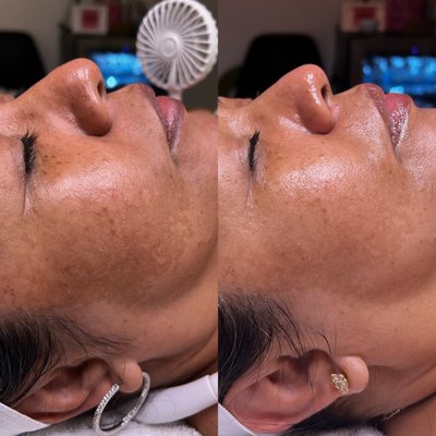 BioRepeel Before and After - These photos were taken 4 weeks apart, clearing up melasma one appointment at a time! Book your consultations and get started on your skincare journey now! BioRepeel Before and After - These photos were taken 4 weeks apart, clearing up melasma one appointment at a time! Book your consultations and get started on your skincare journey now!