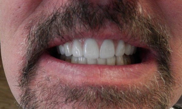 Is It Time To Get Your Teeth Cleaned? - Most dental hygienists recommend having the teeth professionally cleaned every six months. More frequent cleaning and examination may be necessary during treatment of dental and other oral disorders. Routine examination of the teeth is recommended at least every year. This may include yearly, select dental X-rays. See also dental plaque identification procedure and removal.
Good oral hygiene helps to prevent cavities, tartar build-up, and gum disease. Schedule you appointment today Is It Time To Get Your Teeth Cleaned? - Most dental hygienists recommend having the teeth professionally cleaned every six months. More frequent cleaning and examination may be necessary during treatment of dental and other oral disorders. Routine examination of the teeth is recommended at least every year. This may include yearly, select dental X-rays. See also dental plaque identification procedure and removal.
Good oral hygiene helps to prevent cavities, tartar build-up, and gum disease. Schedule you appointment today