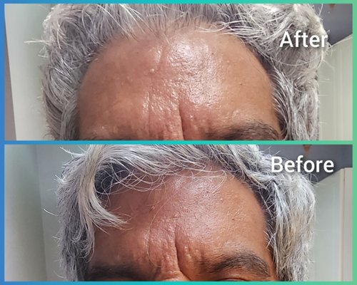 Before and After - The result of Hydrafacial only one treatment Before and After - The result of Hydrafacial only one treatment