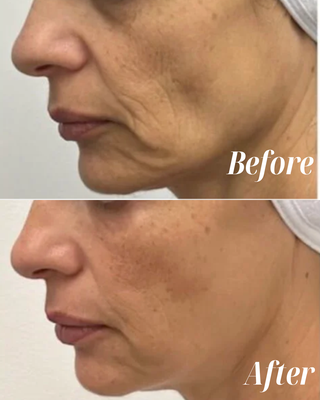 Sculptra - Sculptra is a biostimulatory injectable that gradually restores facial volume by stimulating your body’s natural collagen production. Unlike traditional fillers, Sculptra works deep within the skin to rebuild structure and improve skin firmness over time—resulting in a subtle, long-lasting rejuvenation that can last up to two years. Ideal for treating volume loss, hollow areas, and skin laxity. Sculptra - Sculptra is a biostimulatory injectable that gradually restores facial volume by stimulating your body’s natural collagen production. Unlike traditional fillers, Sculptra works deep within the skin to rebuild structure and improve skin firmness over time—resulting in a subtle, long-lasting rejuvenation that can last up to two years. Ideal for treating volume loss, hollow areas, and skin laxity.