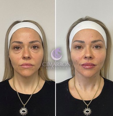Collagen Stimulator - Sculptra® is an injectable solution that triggers the production of collagen, which helps rebuild the areas affected by age-related volume loss and sagging. After your Sculptra® treatment at Cimarron Aesthetics, collagen production gradually increases, making the volume-enhancing results of the treatment apparent over time. Sculptra® can help improve the appearance of sagging jowls, hollow temples, and diminished cheeks and creates a fuller, more youthful appearance. Sculptra® has longer lasting results than some other cosmetic dermal fillers like Restylane and Juvederm. The results can last for up to two years. In most patients a total of 6 vials is needed split between 3 treatments 6 weeks apart.